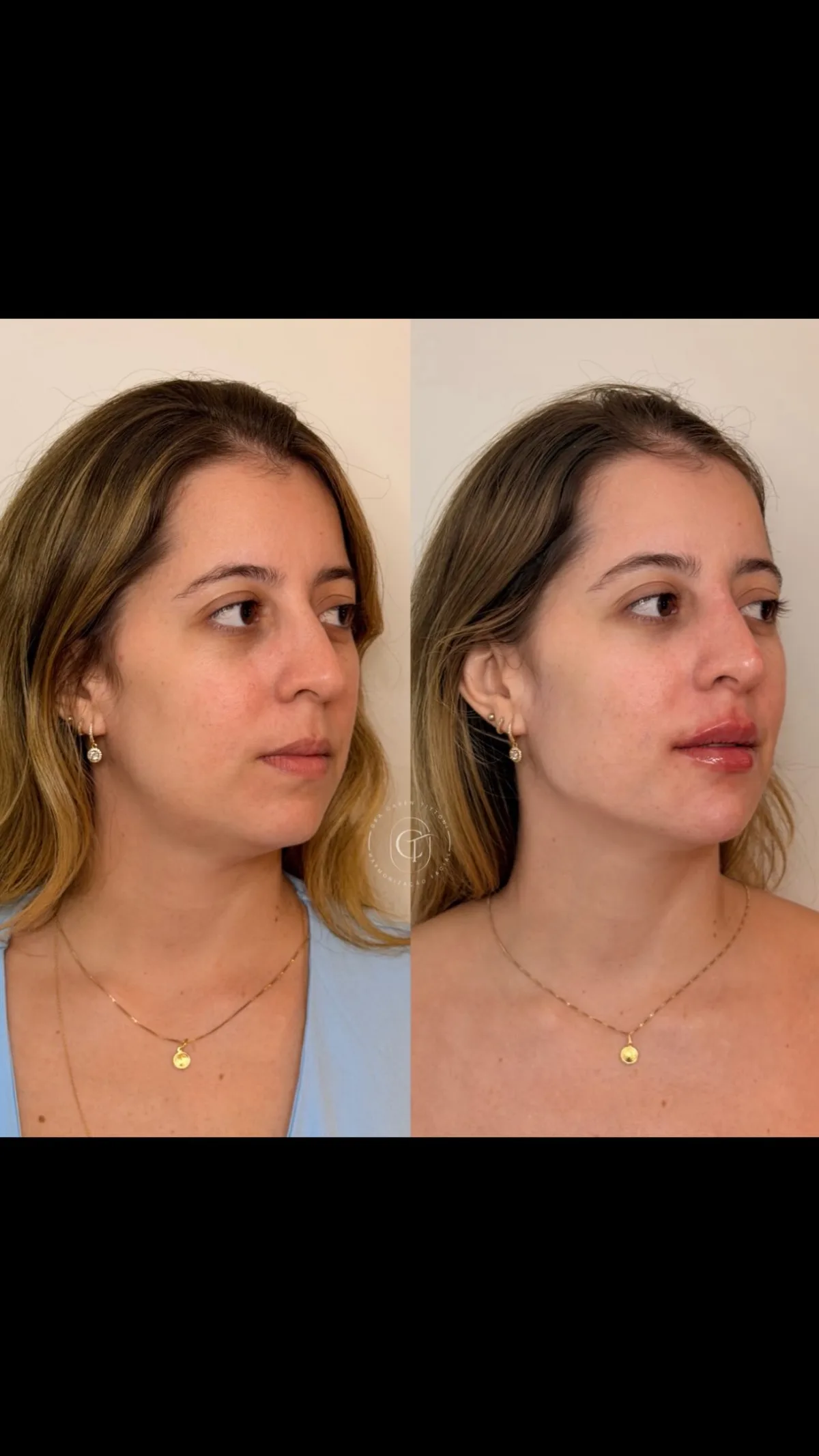 Harmonização facial