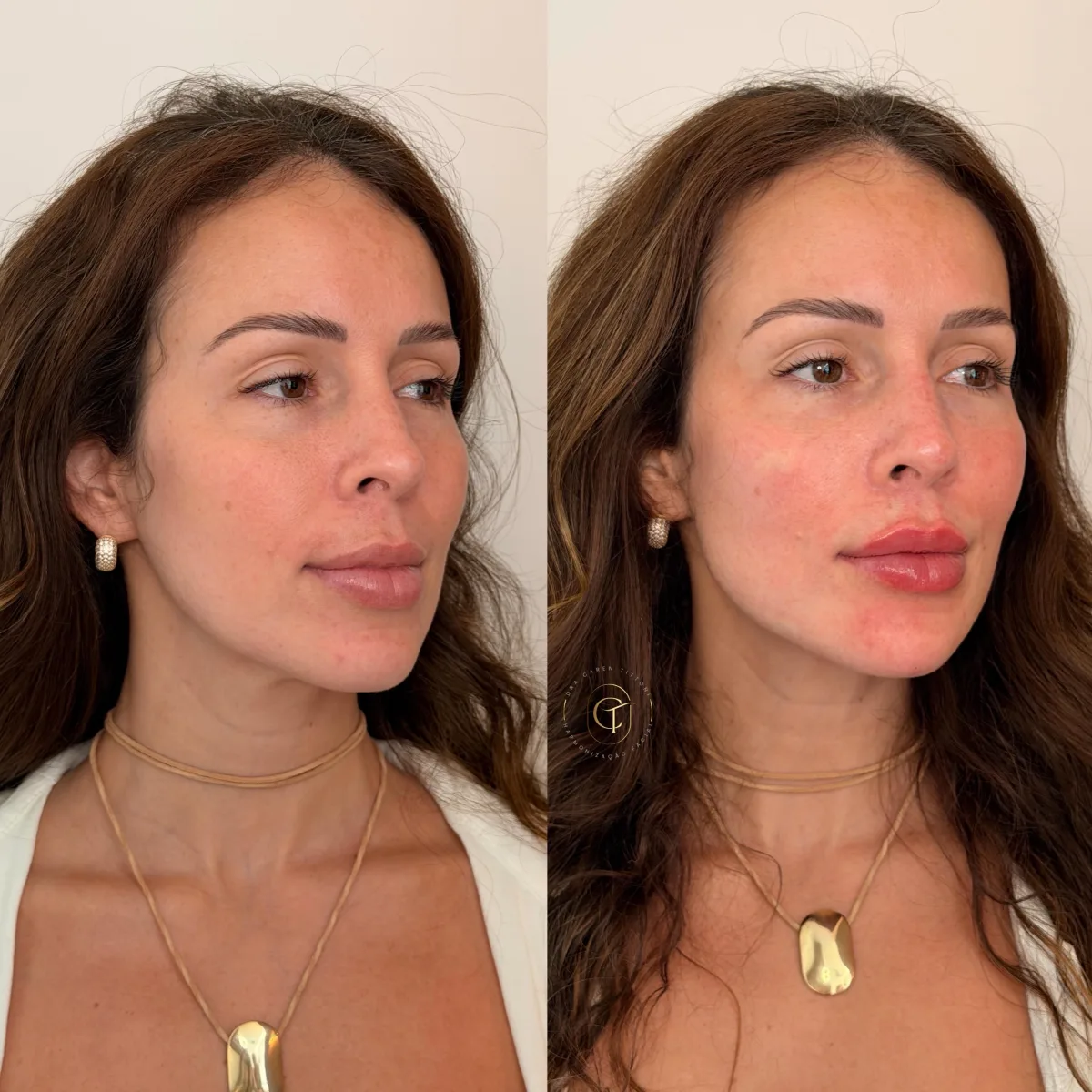 Perfiloplastia