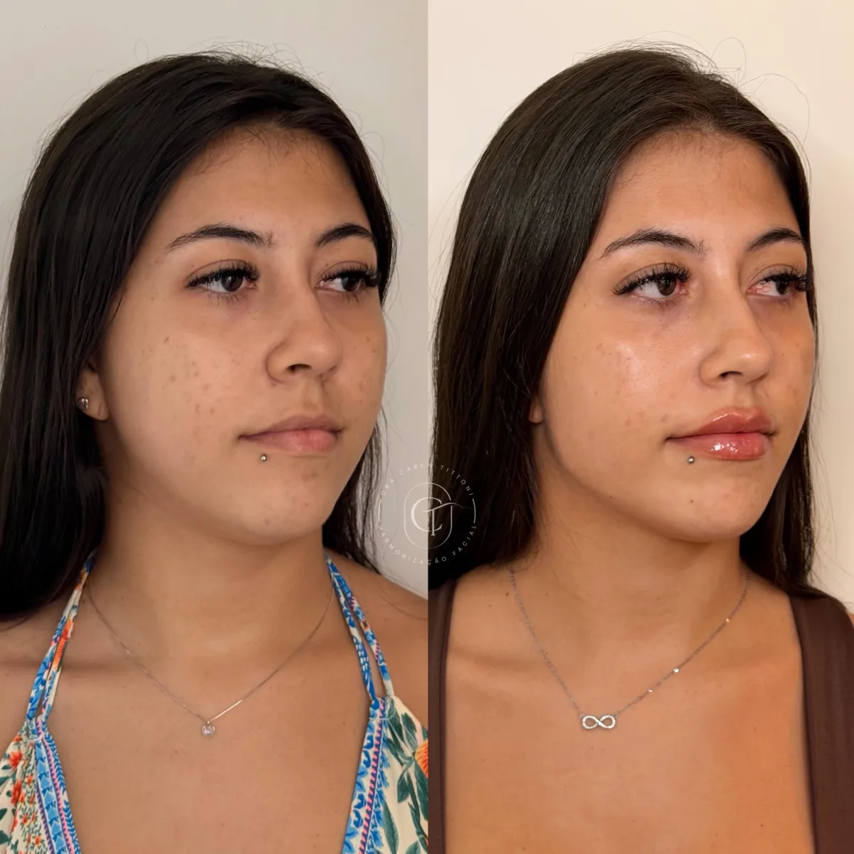 Harmonização facial