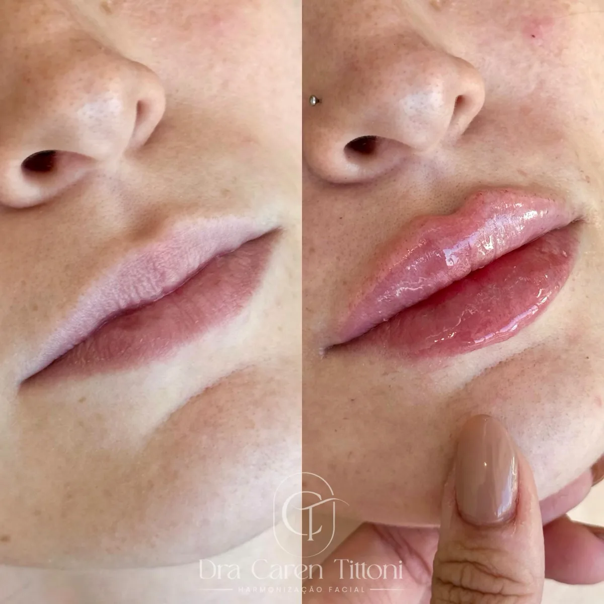 Contorno mandibular e papada