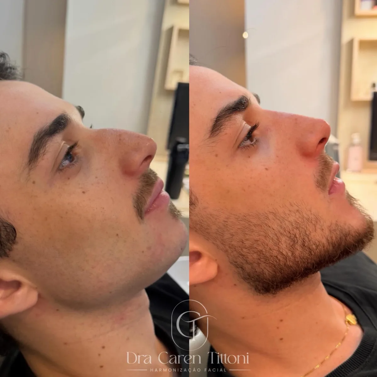 Retorno de um full face que realizamos após 60 dias… e o resultado continua incrível.