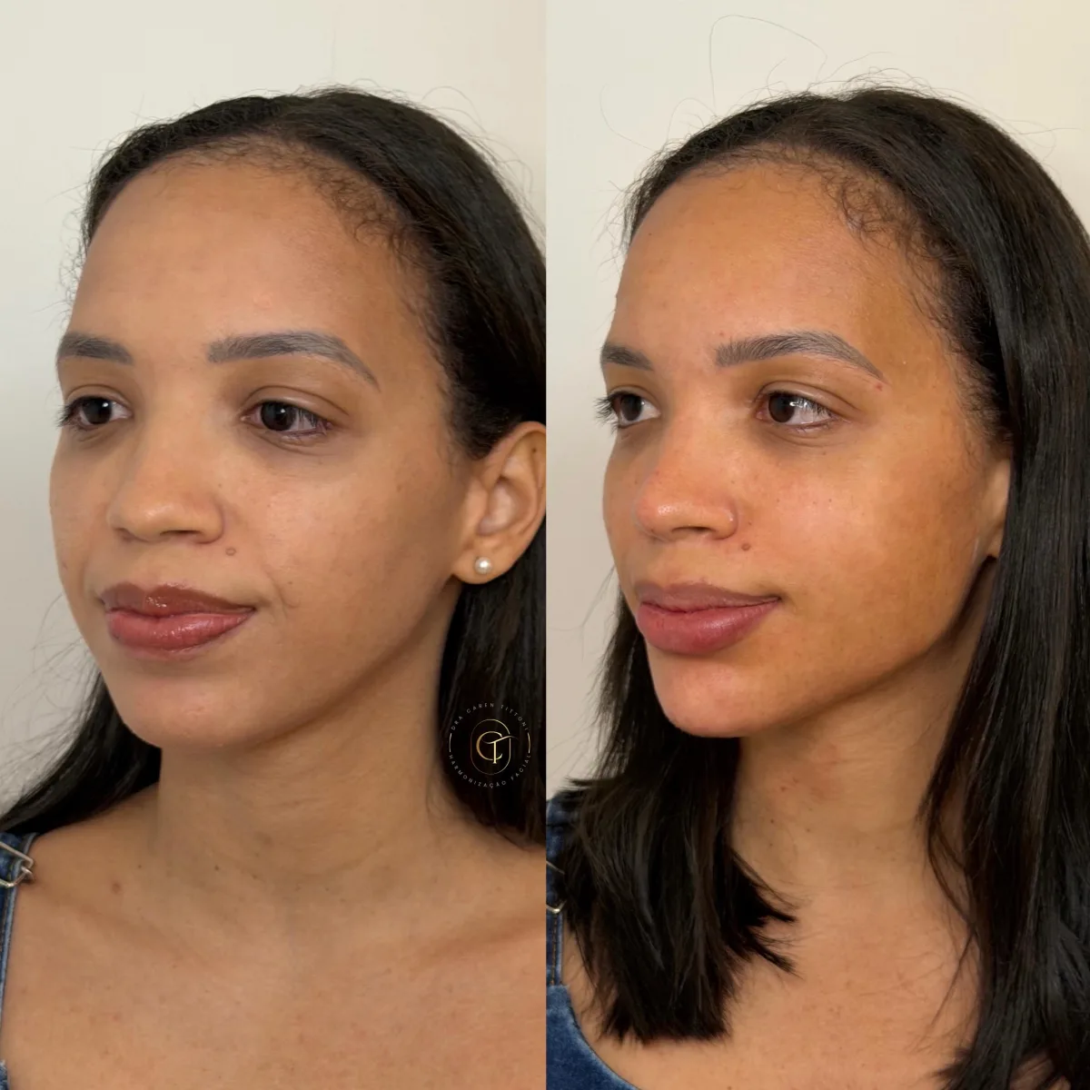Harmonização facial