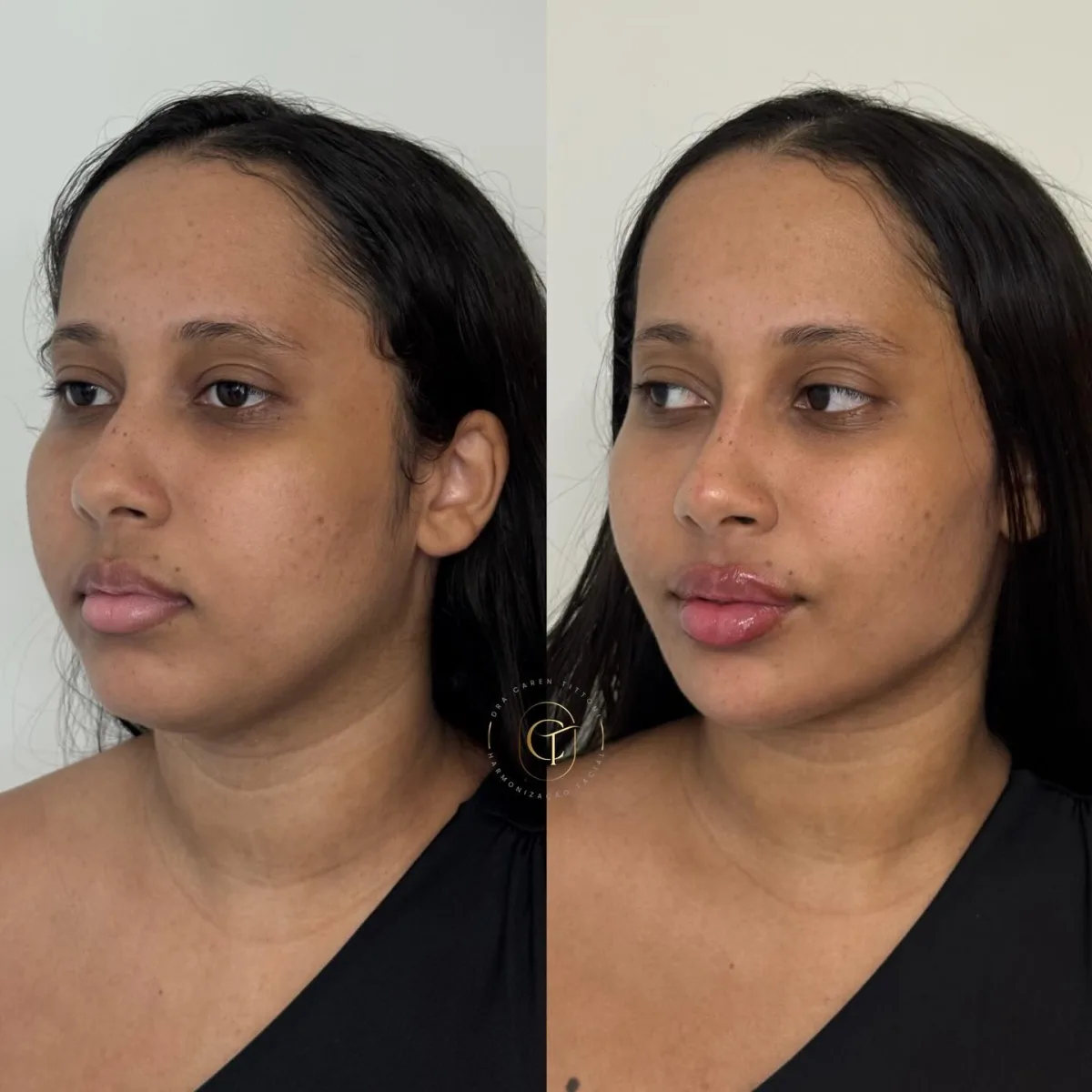 Harmonização facial