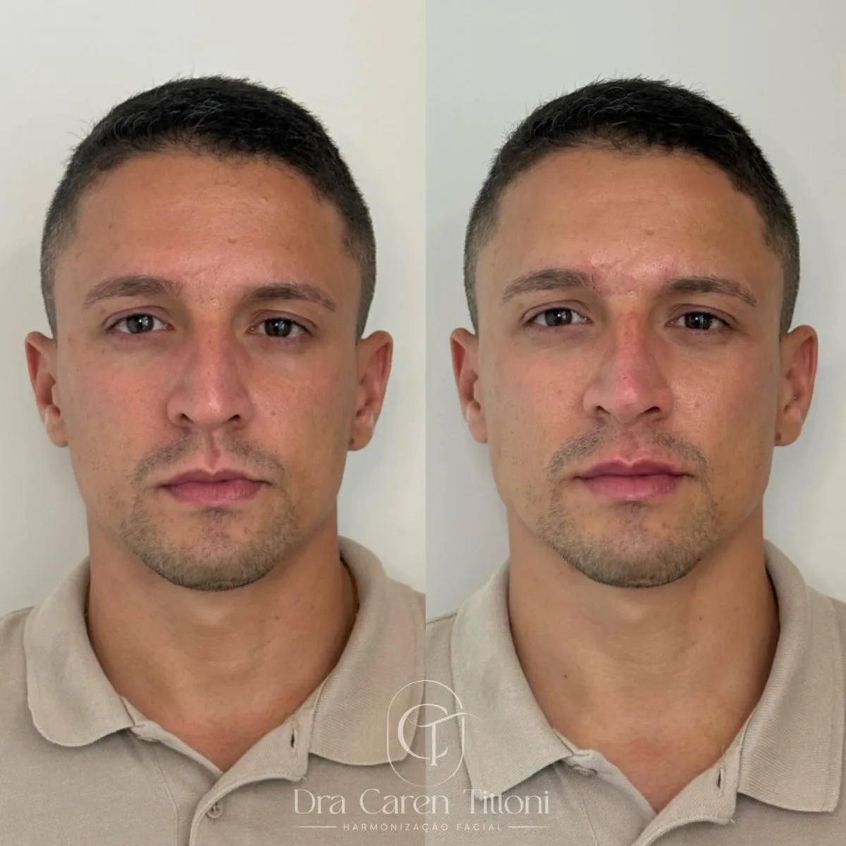 Resultado de um full face pensado para harmonizar sem exageros