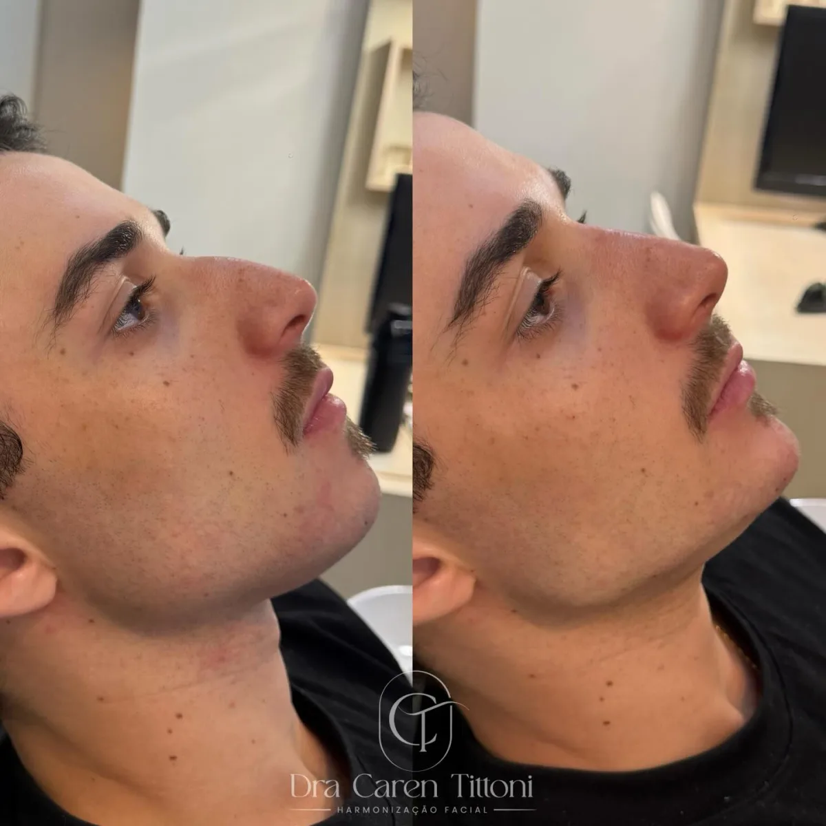 Harmonização facial