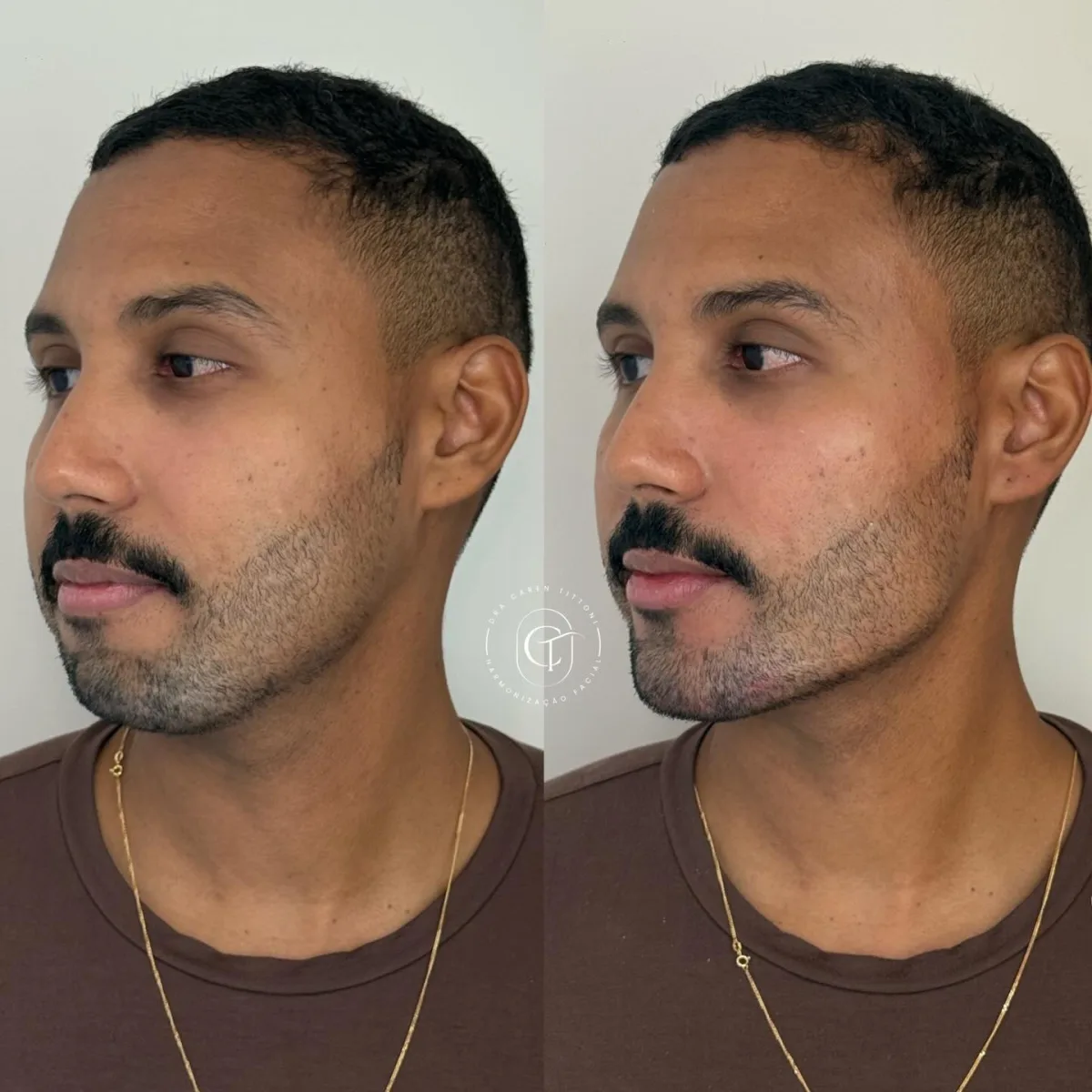 Poucas pessoas imaginam o quanto um queixo retraído pode impactar na autoestima masculina.