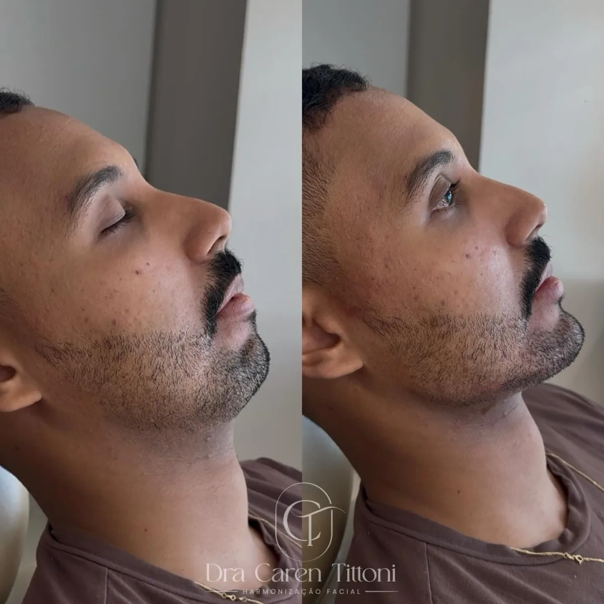 Perfiloplastia com Full Face que respeita a essência, mas transforma os detalhes