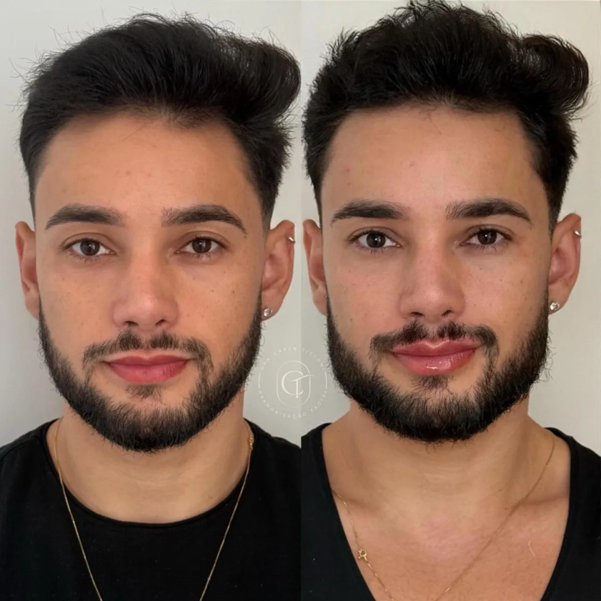 Harmonização masculina com 7ml