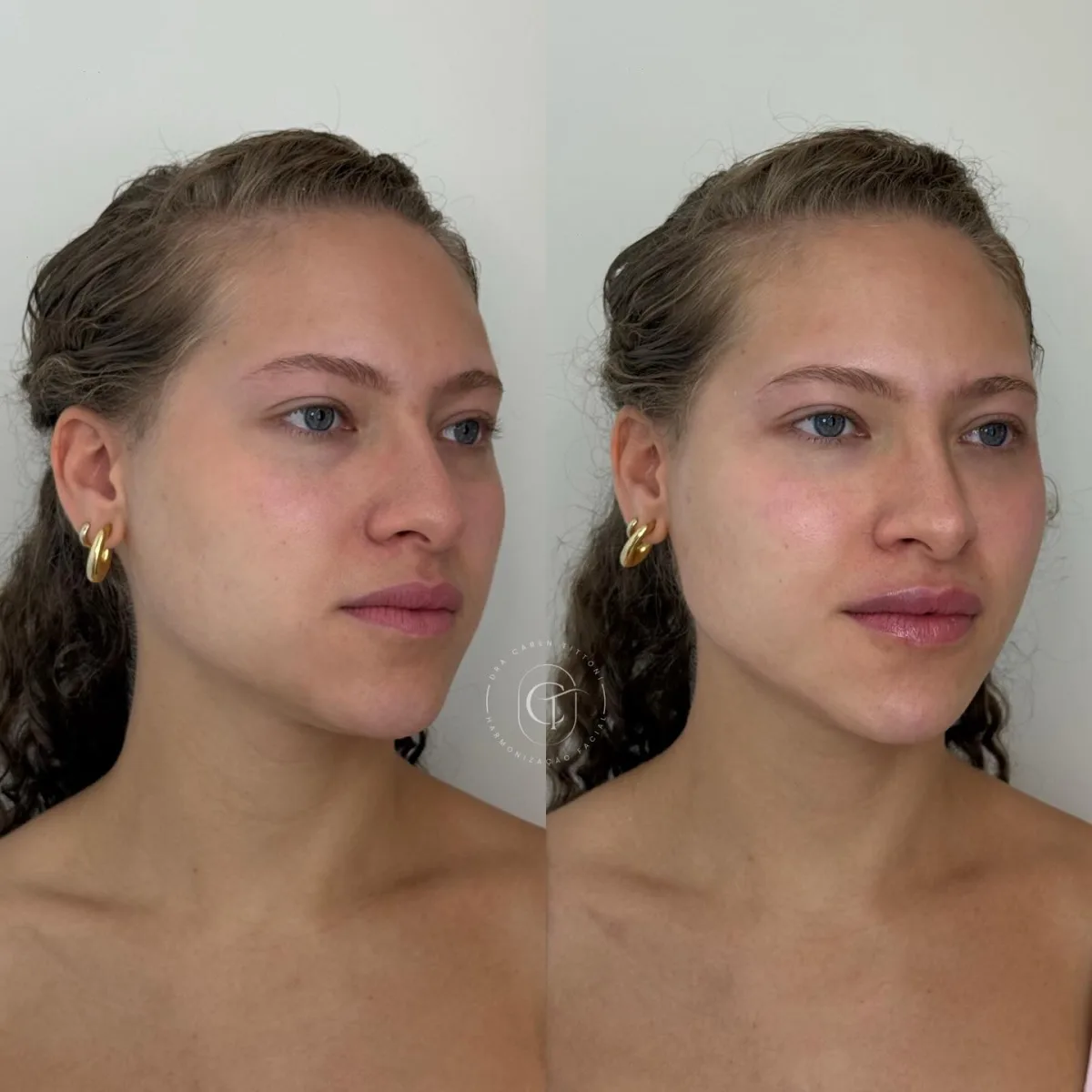 Perfiloplastia com Full Face