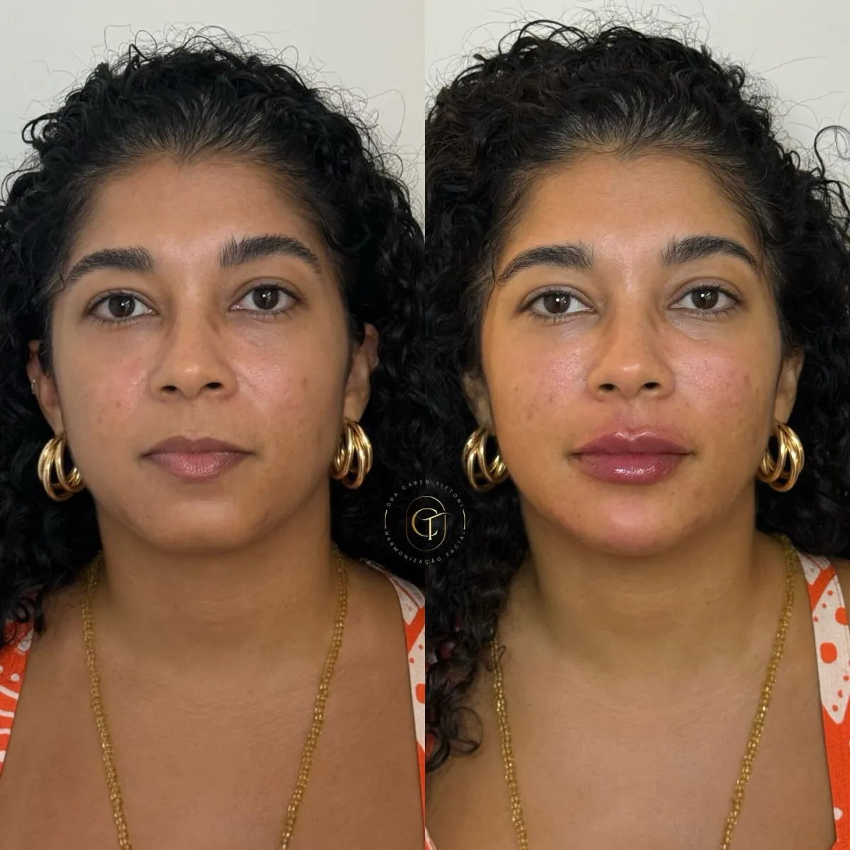 Harmonização facial