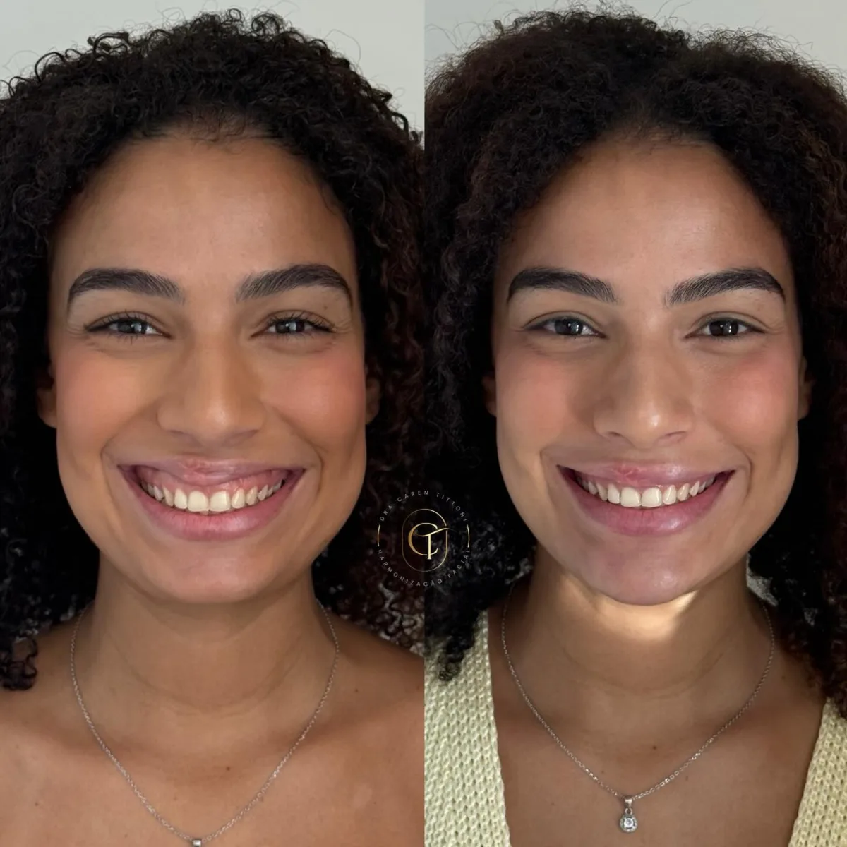 Harmonização facial
