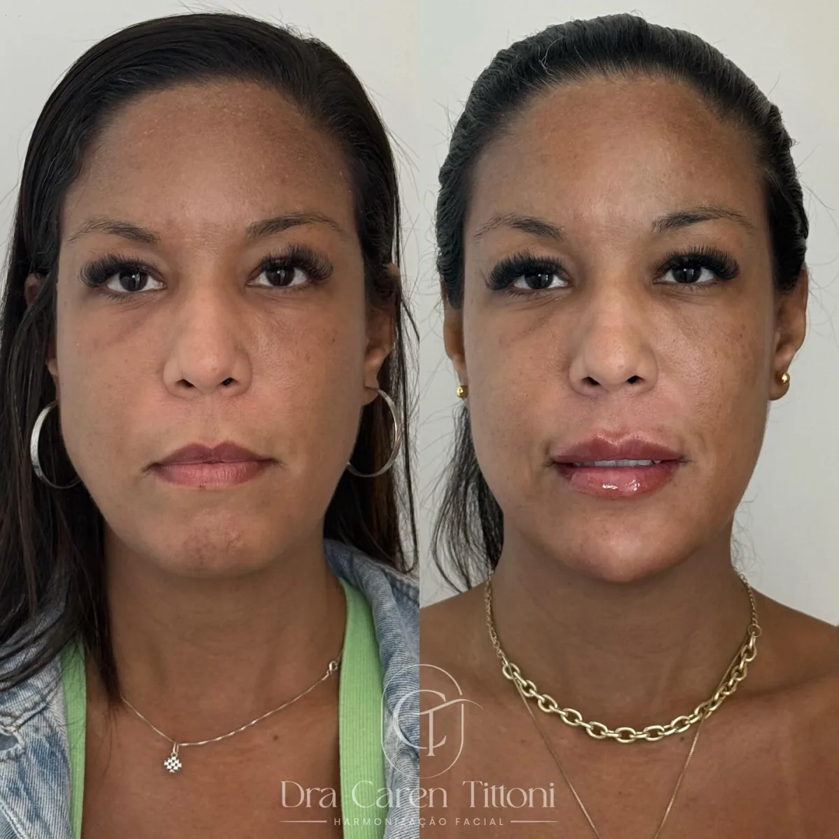 O quanto o queixo retraído e tirar uma foto de perfil te incomoda?