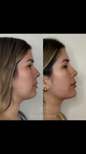 Contorno mais definido, sem papada aparente e sem cortes ou cirurgia ➡️ apenas c...