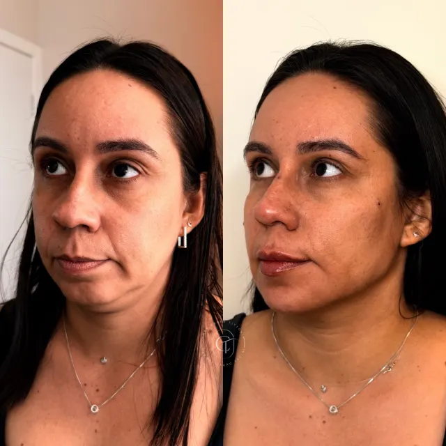 Ela veio para a nossa mentoria Sculpt Face querendo tratar aquilo que mais a inc...