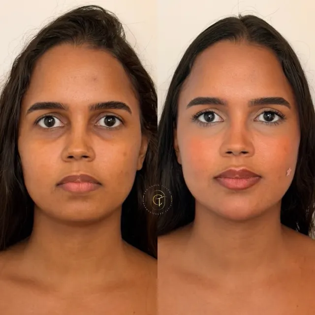 Detalhes sutis que fazem toda diferença 🤍

#harmonizaçãofacial #perfiloplastia
