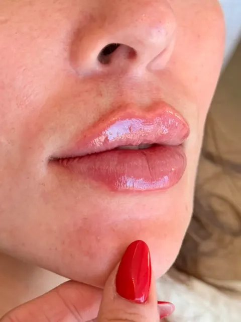 Um lábio lindo para embelezar esse feed 👄✨

#harmonizaçãofacial #preenchimento...