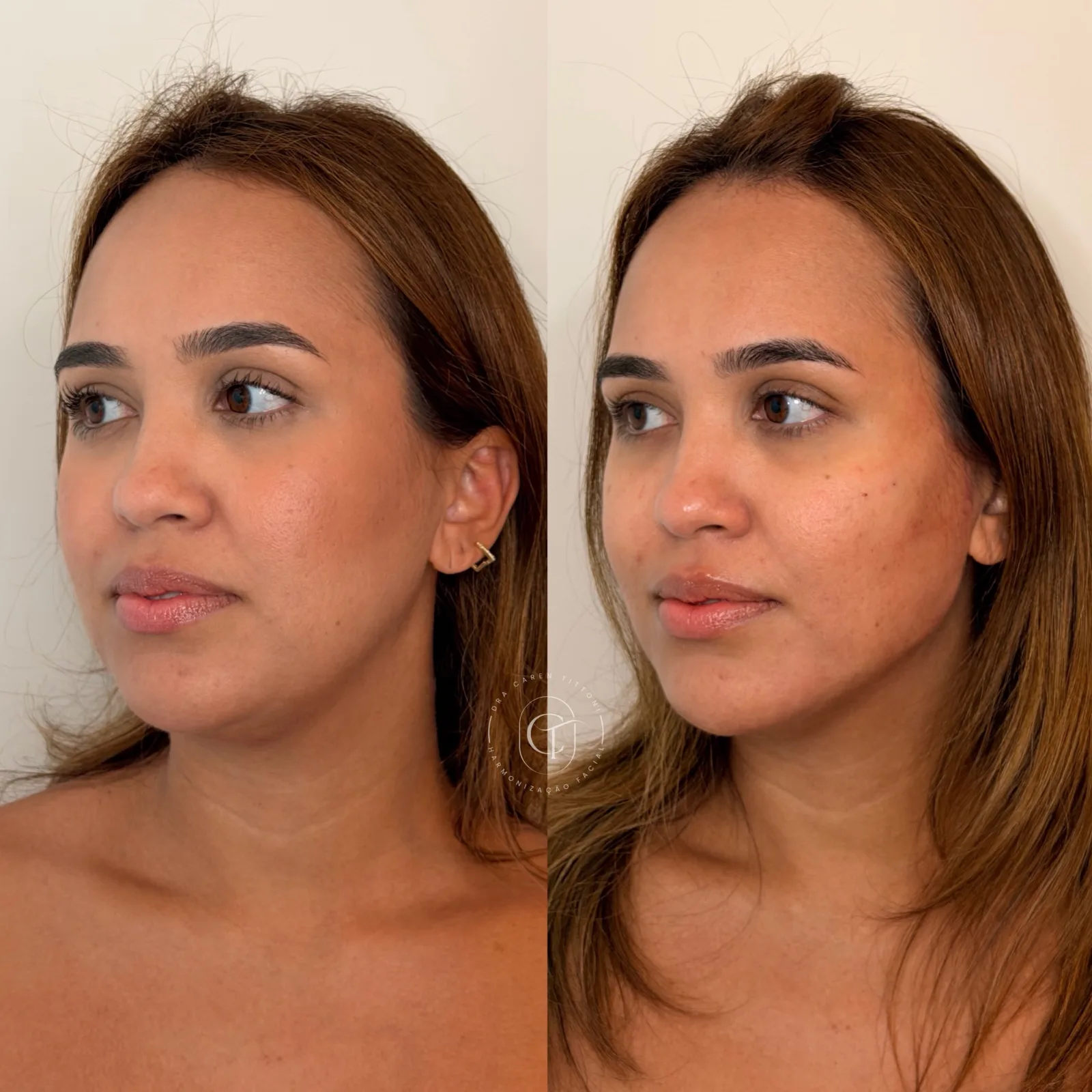 Harmonização facial
