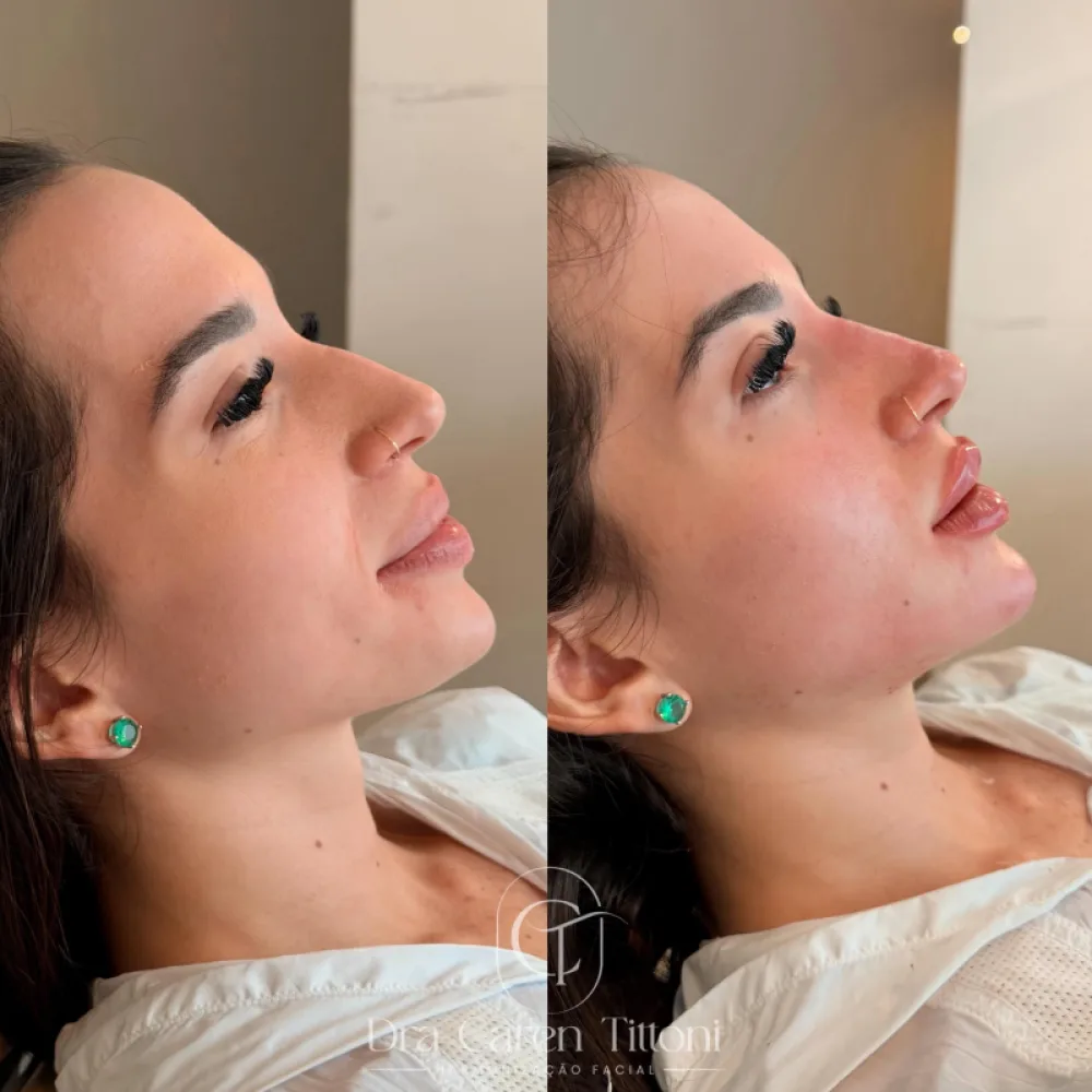 Perfiloplastia
